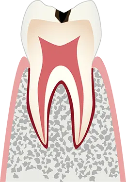 C1 エナメル質の虫歯