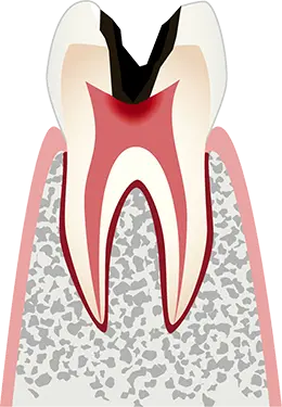 C3 歯髄の虫歯