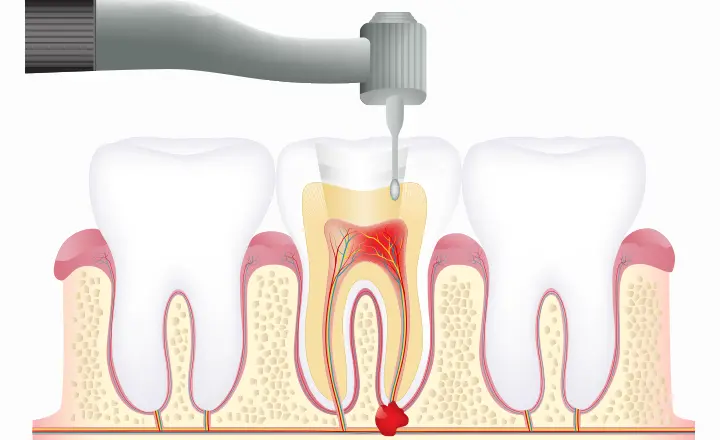 虫歯・歯髄の除去と根管拡大